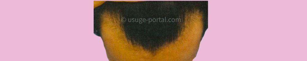 おでこのM字はげ、AGA治療2か月目の写真