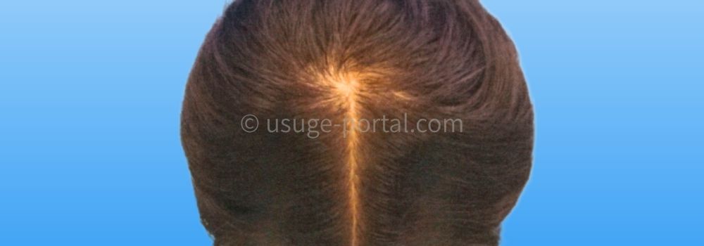 2か月目の頭頂部の様子。初期脱毛なのか部分的にスカって見える気もする。